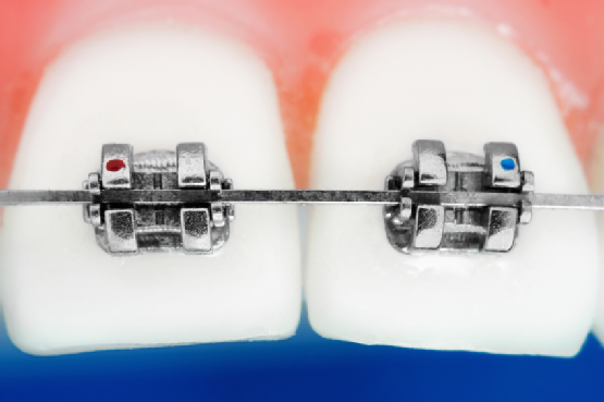 Common Orthodontic Terms You Need to Know