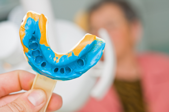 What Are Dental Impressions?