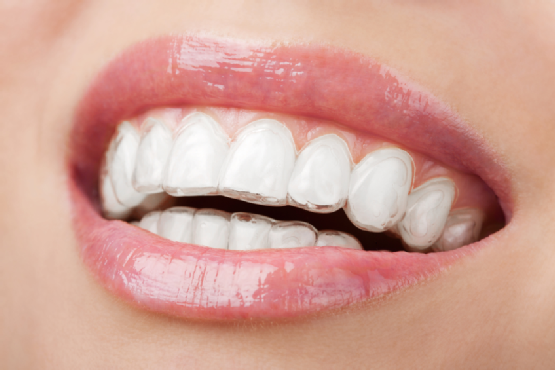 Why Invisalign Is Ideal for Adult Dental Patients