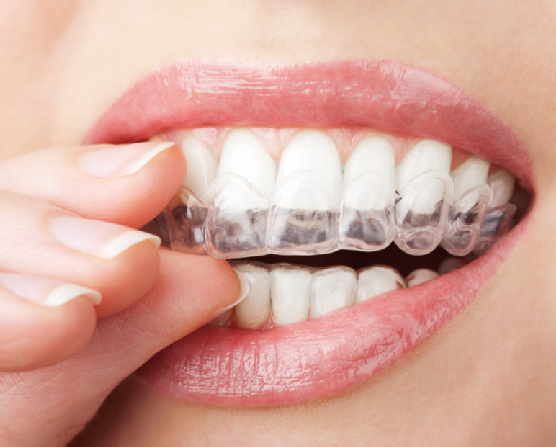 How to Become an Invisalign Patient