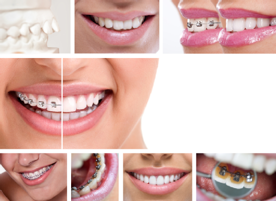 Your Guide to Common Orthodontic Terms
