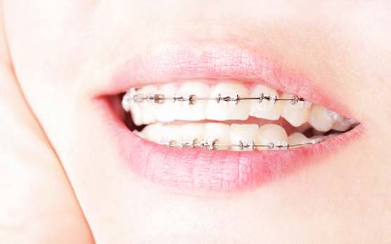 What to Do In Case of Orthodontic Emergencies